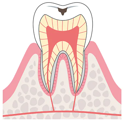 小さいむし歯（C1）