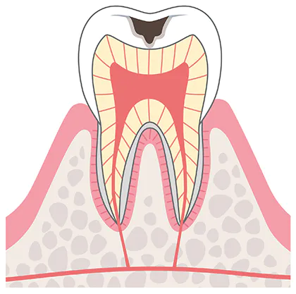 やや大きいむし歯（C２）