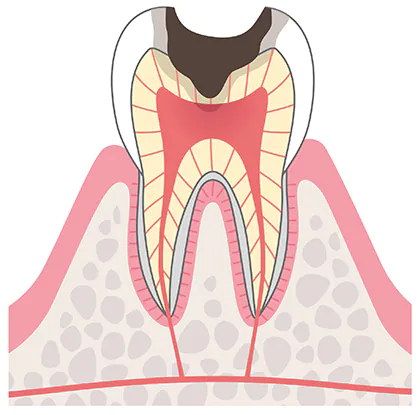 大きいむし歯（C3）