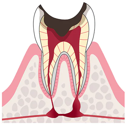 歯根の部分にまで及んだむし歯（C4）