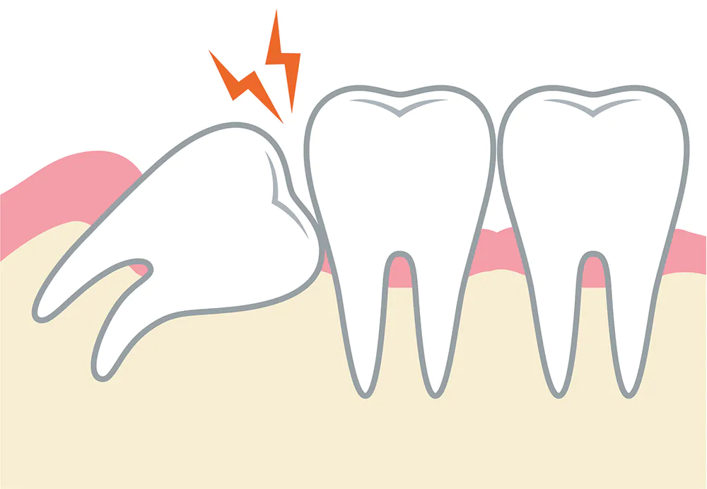 親知らずは抜歯後に注意