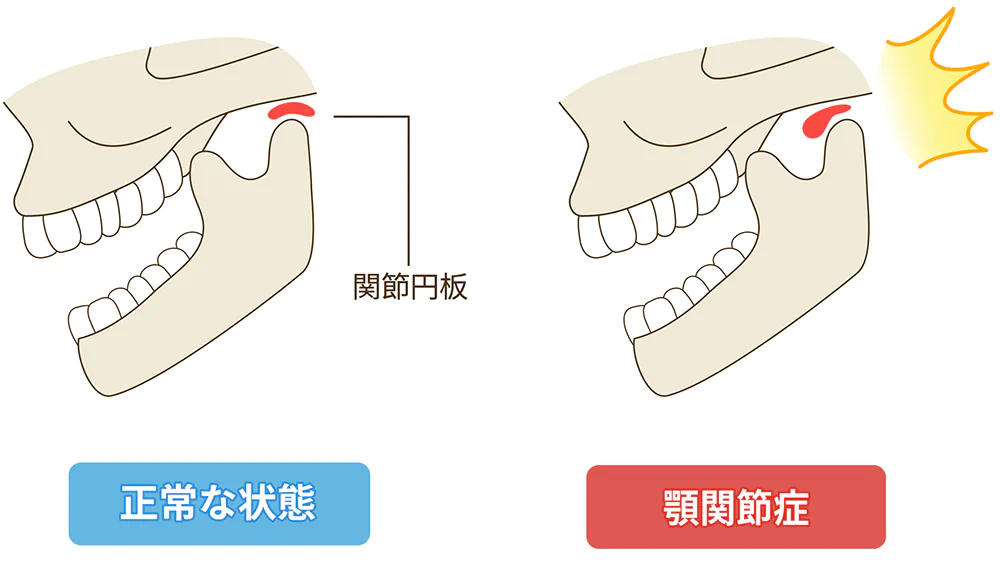 顎関節症でお悩みの方